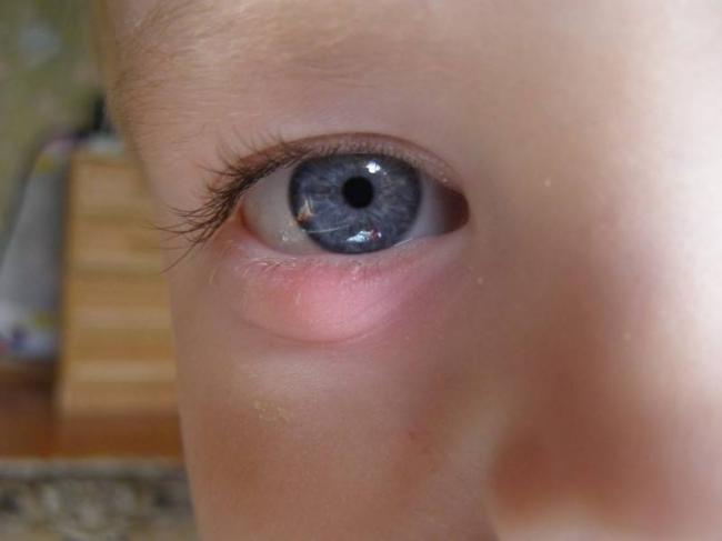 Бактериальный конъюнктивит глаз лечение у взрослых капли