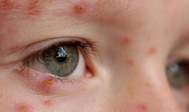 Бактериальный конъюнктивит глаз лечение у взрослых капли