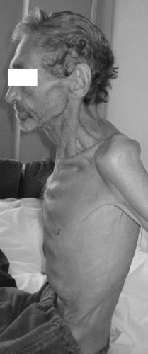 Грудная клетка неправильной формы