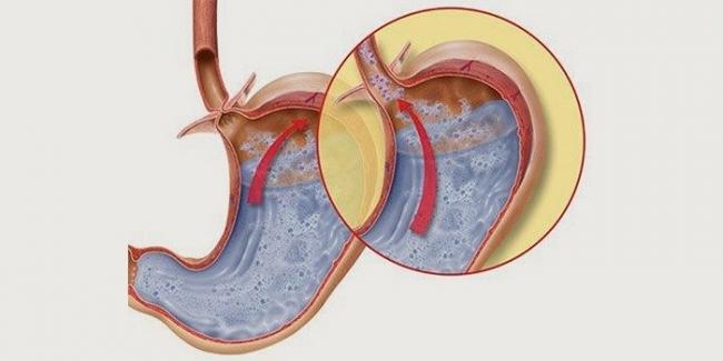 Дуоденогастральный рефлюкс: симптомы дгр, лечение