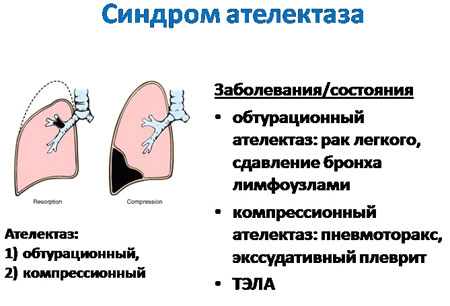 Ателектаз легкого: виды, причины, симптомы и лечение