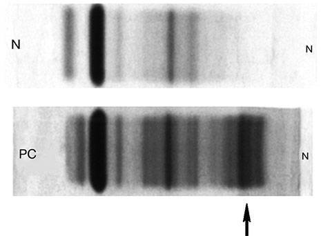 Повторная пневмония у пожилых