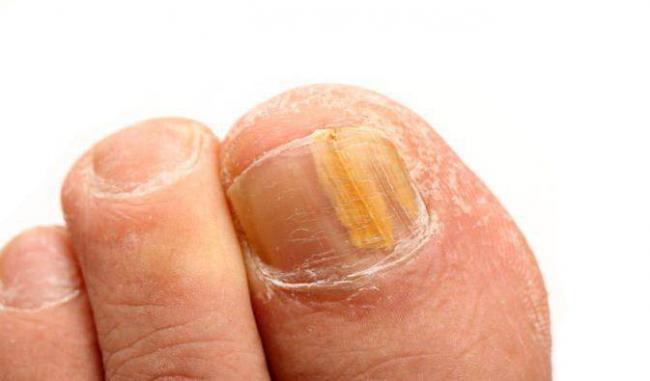 Крем для ног МИКОСТОП от грибка - отзывы