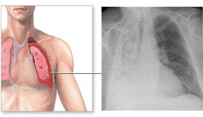 Ателектаз легких у новорожденных - медицинский справочникмедицинский справочник