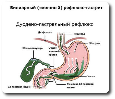 Дуоденo гастральный рефлюкс