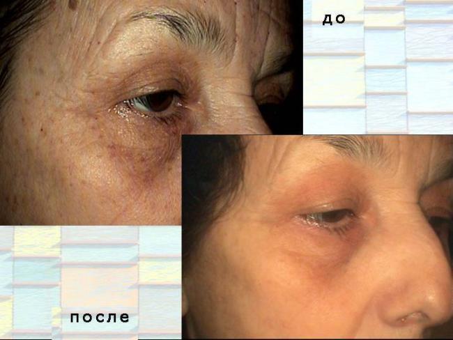 Папиллома на глазу: как удалить папиллому под глазом?