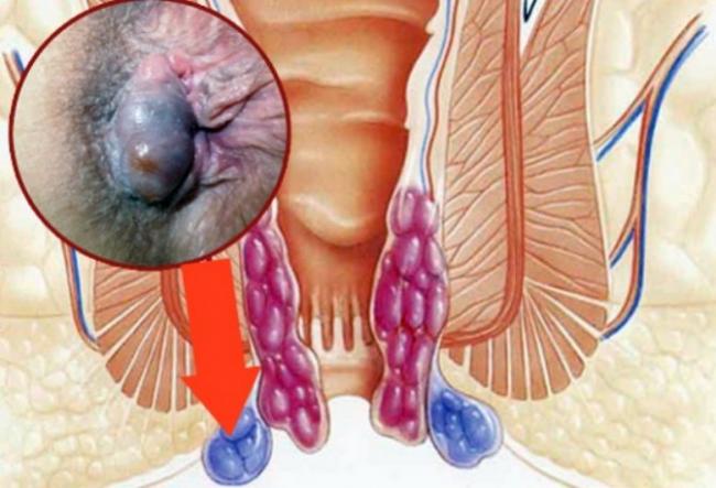 Геморрой и рак: как отличить на ранних стадиях патологии?