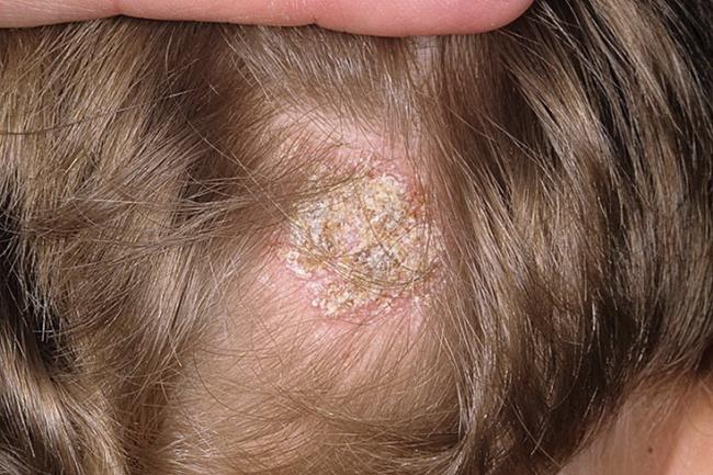 Магнипсор от псориаза: описание и инструкция по применению, особые указания и аналоги