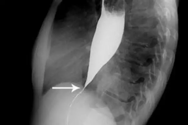Ахалазия кардии. ахалазия пищевода: лечение современными методами и их суть. факторы и группы риска