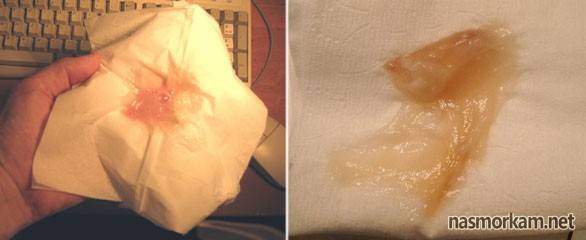 Причины появления выделений из носа