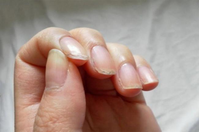Почему слоятся ногти на руках, методы избавления от проблемы в домашних условиях