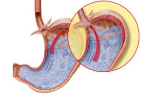 Народное лечение недостаточности кардии желудка