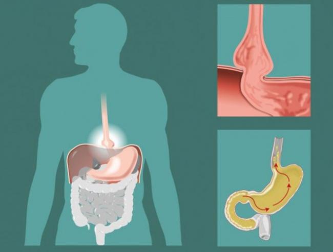 Дуодено-гастральный рефлюкс