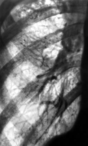 Пневмосклероз легких – что это такое, чем опасен недуг, и как его лечить?