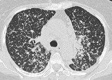 Расшифровка кт: картина фиброзных изменений в легких