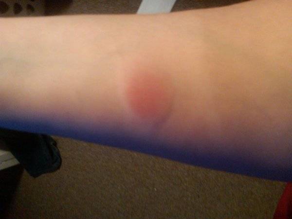 Аллергия на реакцию манту