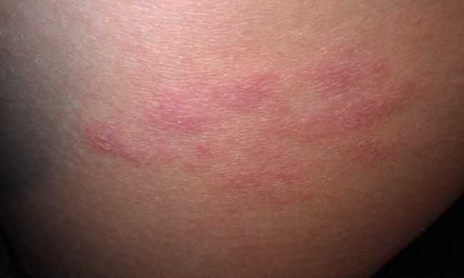 Эконазол аналоги. цены на аналоги в аптеках