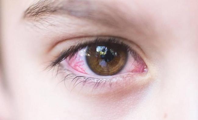 Бактериальный конъюнктивит глаз лечение у взрослых капли