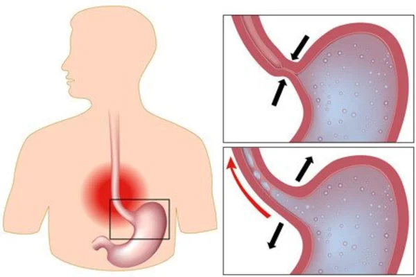 Дуоденогастральный рефлюкс: симптомы и лечение, причины, признаки, прогноз