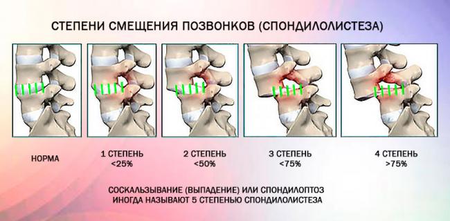 Спондилолистез крестцового отдела позвоночника симптомы