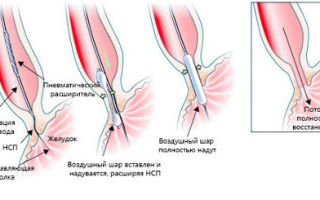 Ахалазия пищевода