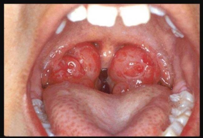 Воспаление миндалин лечение в домашних условиях