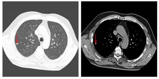 Уточнение диагноза по кт грудной клетки? - вопрос пульмонологу - 03 онлайн
