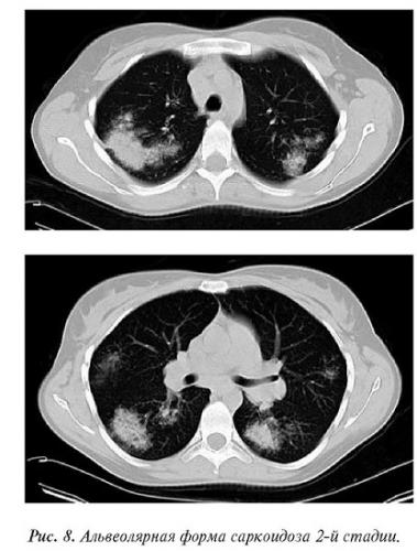 Очаги в лёгких на кт: классификация образований