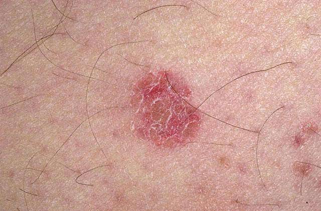 Неоспорин мазь инструкция по применению, аналоги, отзывы Подробнее