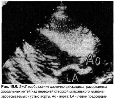 Одышка при сердечной недостаточности – лечение и характерные признаки