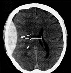 Застойная пневмония у лежачих больных: симптомы, лечение, профилактика