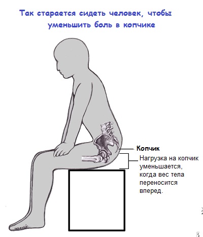 Кокцигодиния – симптомы, лечение
