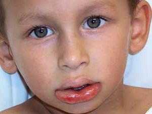 Ангионевротический отёк