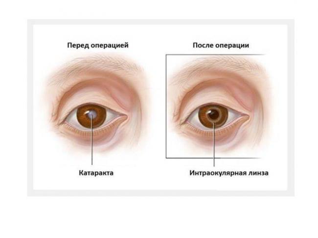 Мультифокальные торические иол