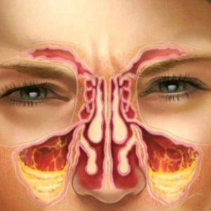 Сумамед и азитромицин при гайморите: дозировка и правила приёма