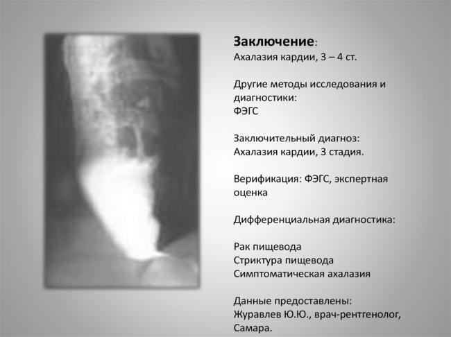 Кашель при ахалазии кардии