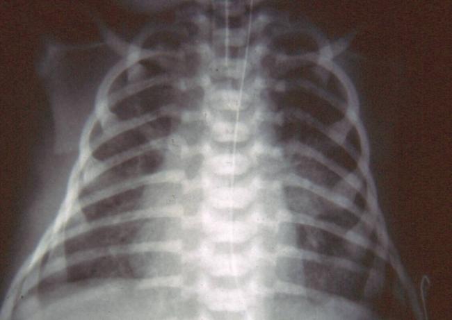 Симптоматика, диагностика и лечение аспирационной пневмонии у новорожденных