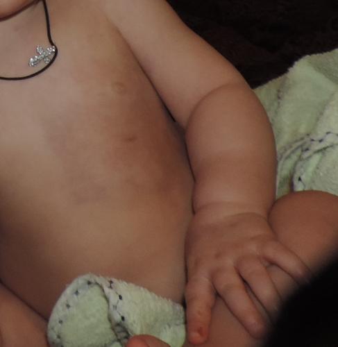 Боль в копчике или в области копчика - причины, характеристика, методы лечения