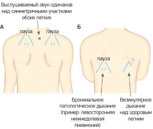 Кашель и хрипы пневмонии и бронхита нет