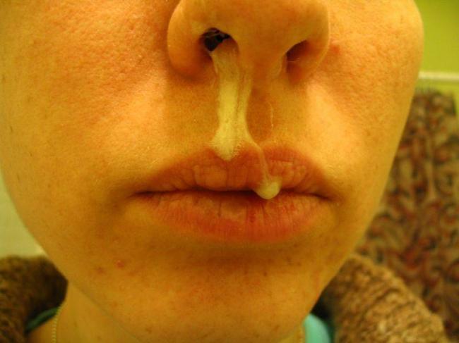 Сопли жёлтого цвета — причины их образования и методы лечения