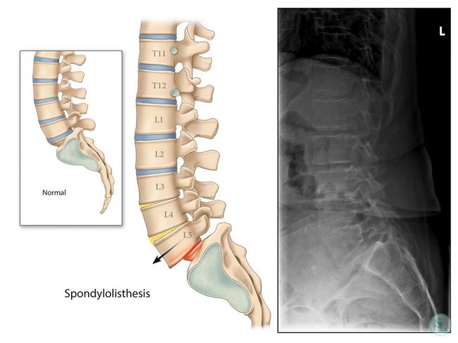 Как лечить смещение позвонков поясничного отдела