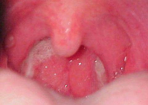 Почему скапливается слизь в носоглотке и как от нее избавиться?