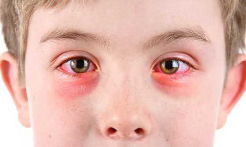 Как лечить хронический конъюнктивит у детей?