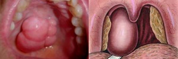 Болит горло с левой стороны больно глотать что делать