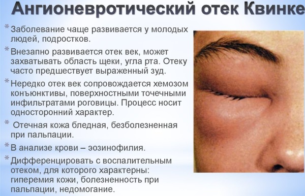 Ангионевротический отек: принципы диагностики и терапии