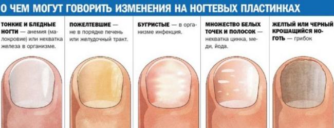 Слоятся, крошатся, ломаются ногти: почему очень тонкие ногти, лечение, что делать в домашних условиях