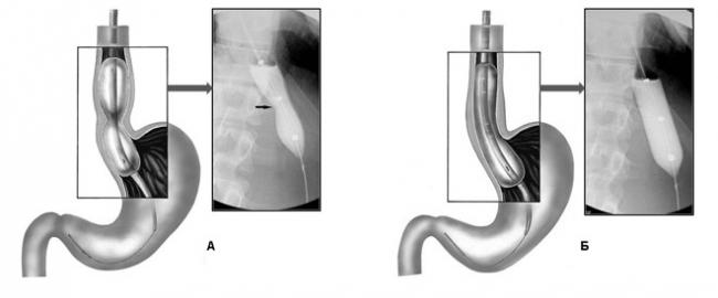 Ахалазия кардии и кардиоспазм