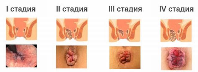 Геморрой и рак: как отличить на ранних стадиях патологии?