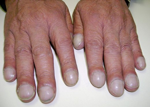 Пневмосклероз легких - что это такое, как лечить