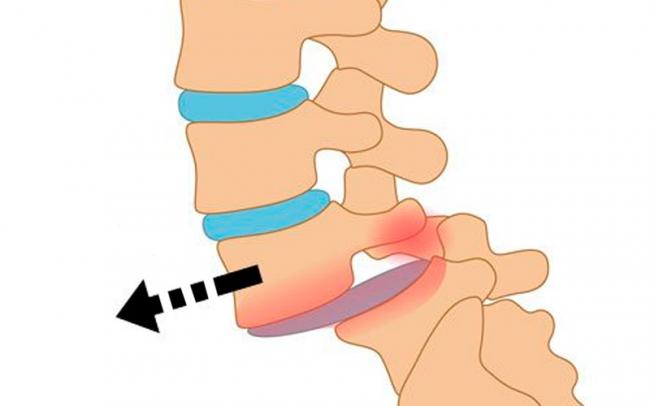 Смещение позвонков поясницы: чем опасно заболевание и как его лечить?